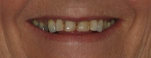 Dental Implant to Replace front Tooth - Whitehorse Dental