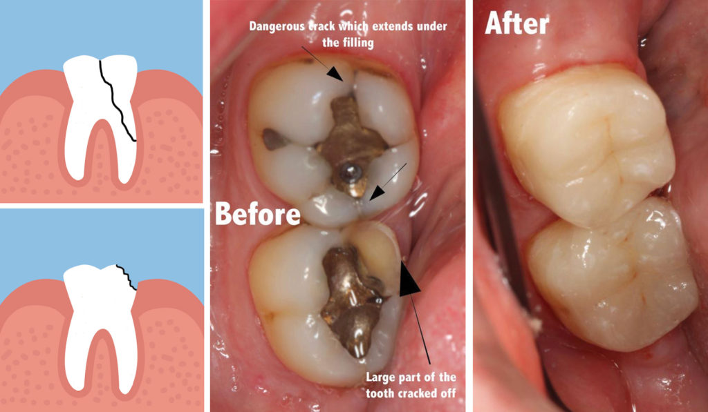 before and after images of a severely cracked tooth treated at Whitehorse Dental in Blackburn