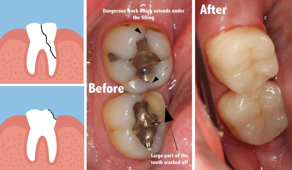 Why are my teeth sensitive to cold? - Whitehorse Dental