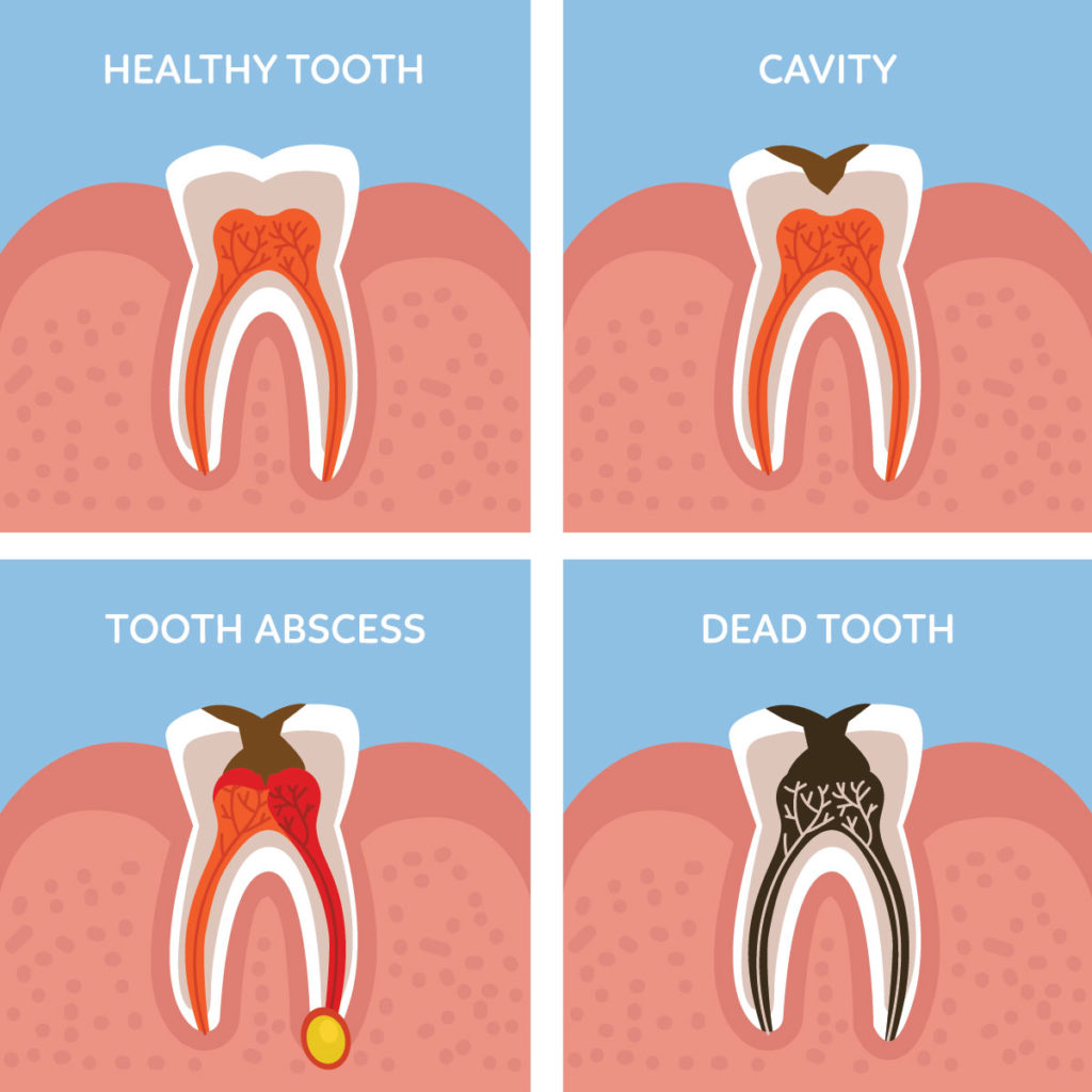 Why Do My Teeth Feel Sensitive To Cold