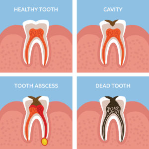 diagram comparing a healthy tooth to tooth decay