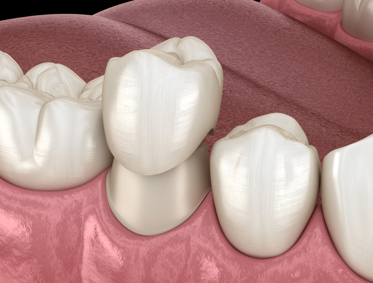 What are Dental Crowns and What Makes Them a Good Choice?