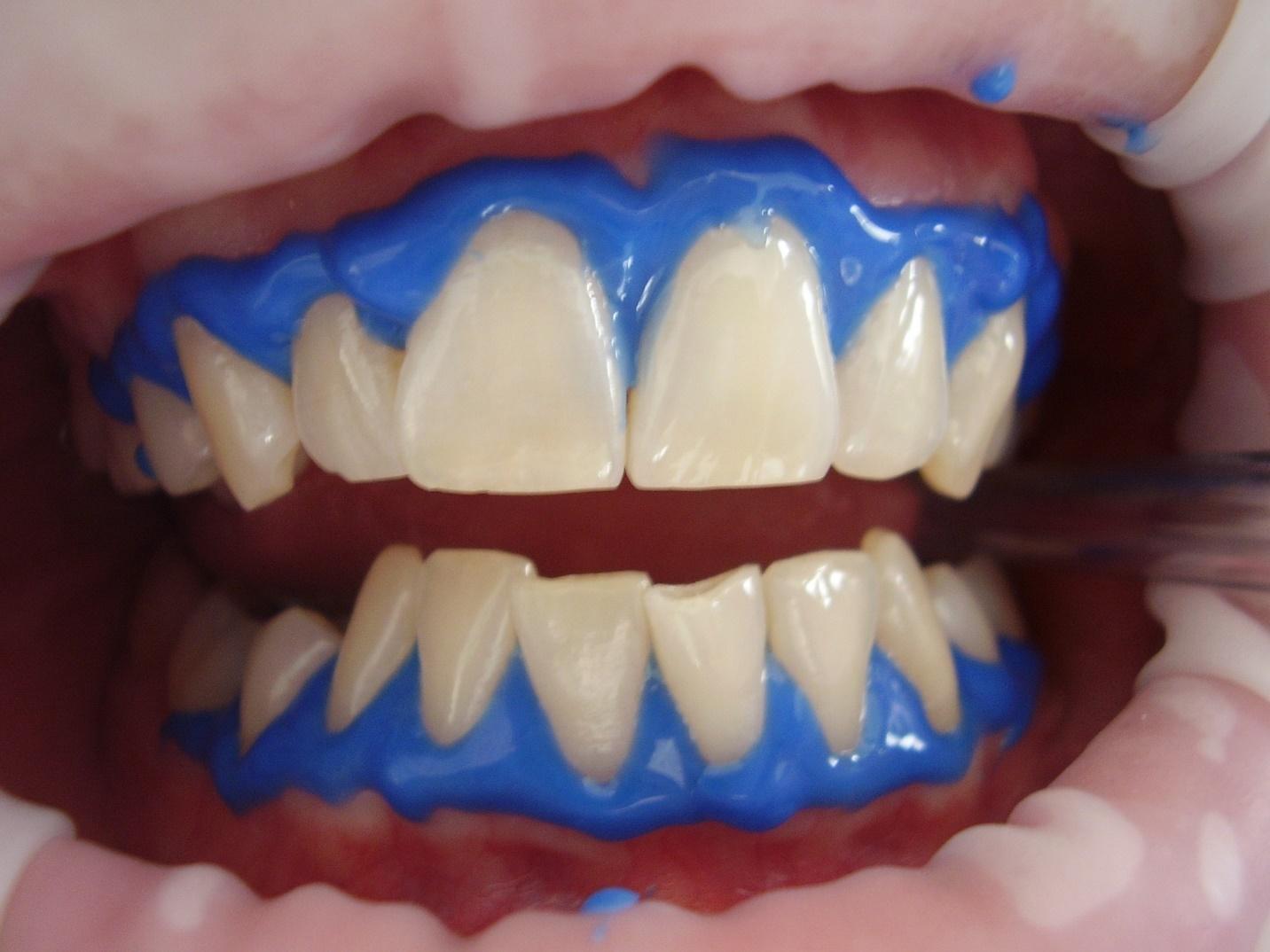 Professional Teeth Whitening Types and Benefits