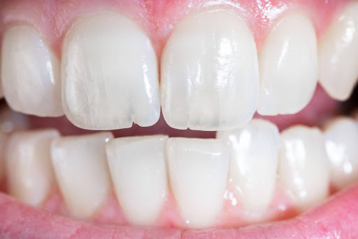 restored teeth