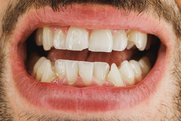 Close Up Of A Teeth Of A Young Man While Preparing For Orthodontist