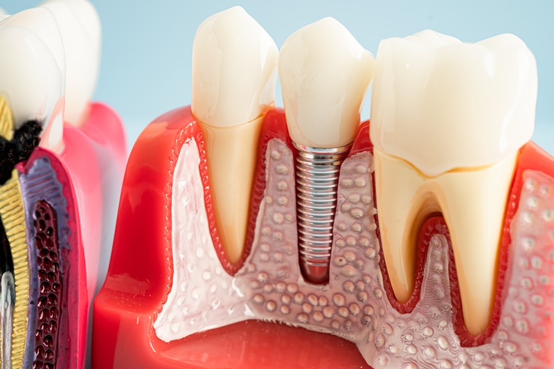 Dental implant, artificial tooth roots into jaw,