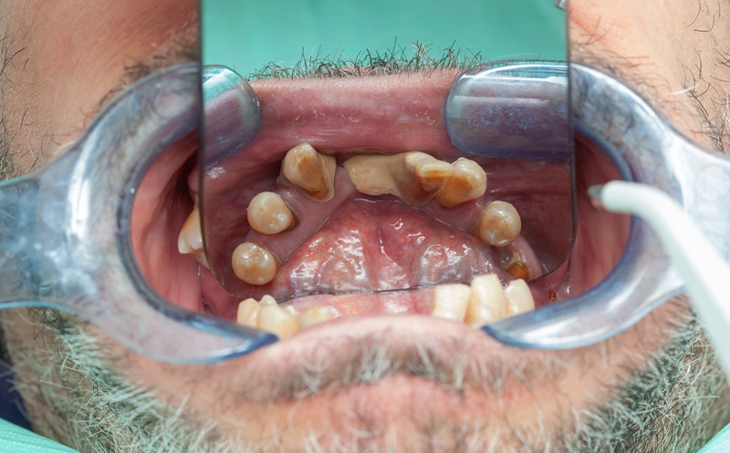 Rotten teeth during inspection with retractor for dental implant