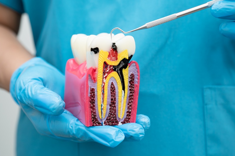 Dentist showing root canal infection