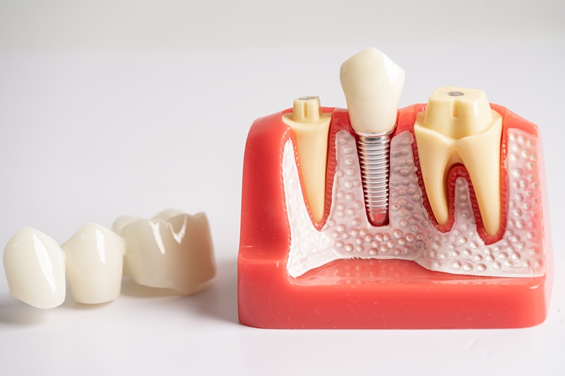 Dental implant, artificial tooth