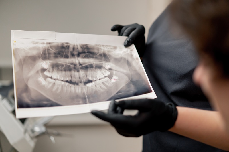 dentist showing mouth xray and marking wisdom tooth