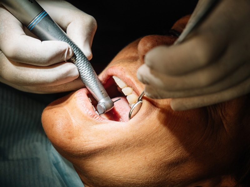 Dentist opens the mouth of his patient and begins to drill