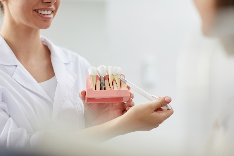 Smiling Dentist showing dental implant sample