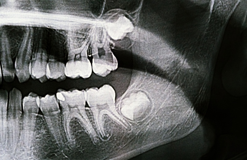 Panoramic X-ray of the jaw. X-ray of the wisdom teeth of a 12-year-old girl.